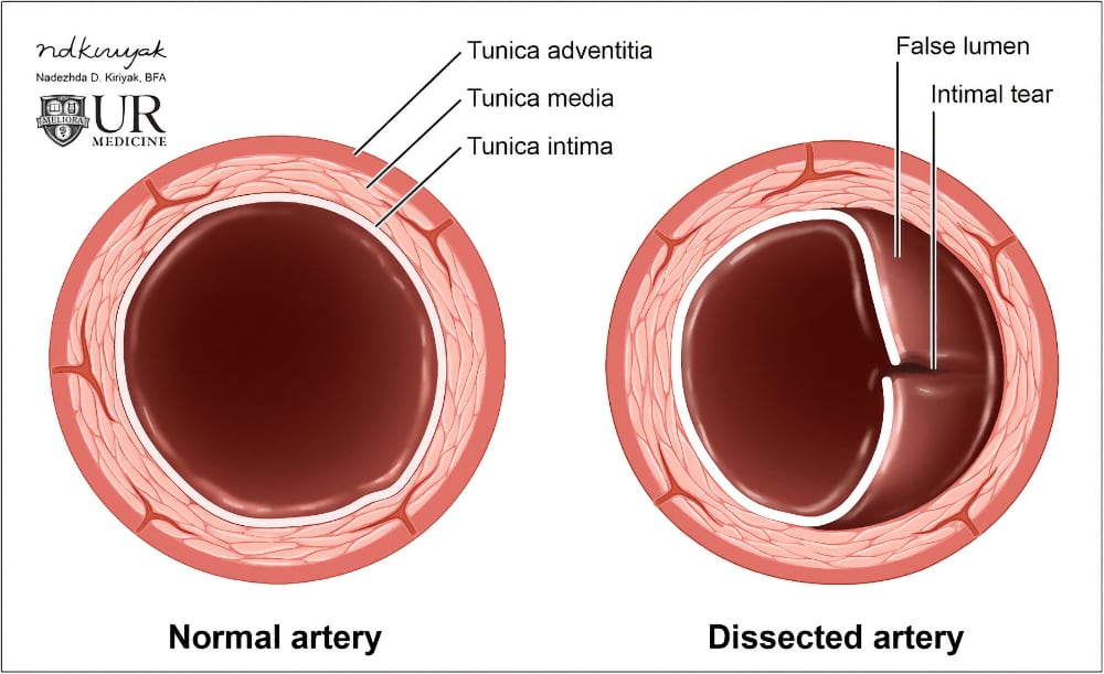 Arterial dissection. Illustration of the normal layers of an arterial vessel (left). Dissection occurs when a tear in the intimal layer allows blood to collect between the tunica intima and tunica media, creating a false lumen (right)