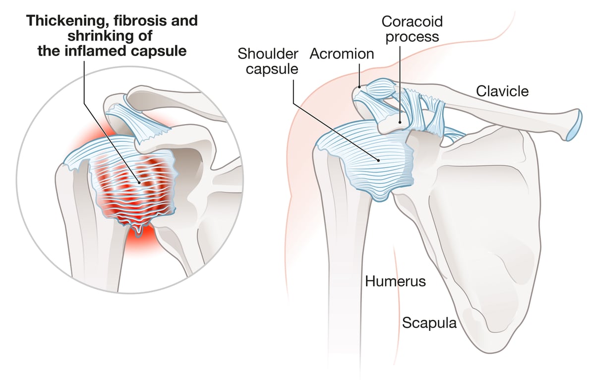 Cross-sectional anatomical illustration of a shoulder joint showing the joint capsule (blue) surrounding the head of the humerus. Labels identify the shoulder capsule, acromion, coracoid process, clavicle, humerus, and scapula. An inset magnifies the capsule in a diseased state, depicting it as thickened, fibrotic, inflamed, and contracted around the joint, with red shading indicating inflammation. The illustration emphasizes the capsule shrinking and stiffening in frozen shoulder (adhesive capsulitis).