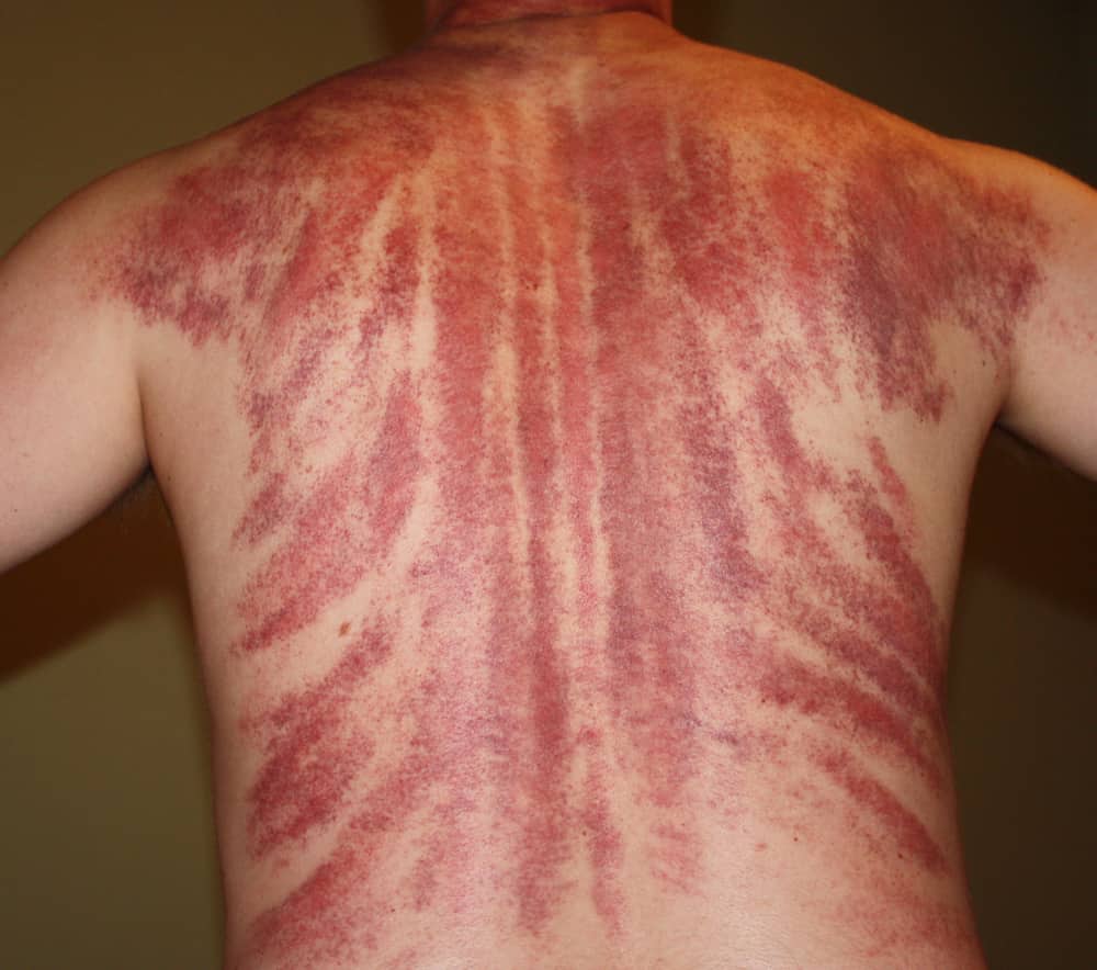 Photo of post-gua sha petechiae on a person’s back: broad streaks of subcutaneous hemorrhage in red and purple tones, running vertically along the spine and diagonally across the paraspinal muscles and scapular regions.