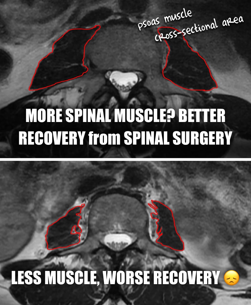 Two axial MRI images of the lower spine show the cross-sectional area of the psoas muscles outlined in red. The top image displays larger, well-defined psoas muscles, with handwritten labels identifying them as “psoas muscle” and “cross-sectional area.” Caption reads: “MORE SPINAL MUSCLE? BETTER RECOVERY from SPINAL SURGERY.” The bottom image shows smaller, atrophied psoas muscles with irregular outlines, accompanied by the caption: “LESS MUSCLE, WORSE RECOVERY 😞.” The visual comparison emphasizes a correlation between spinal muscle mass and recovery outcomes after spinal surgery.