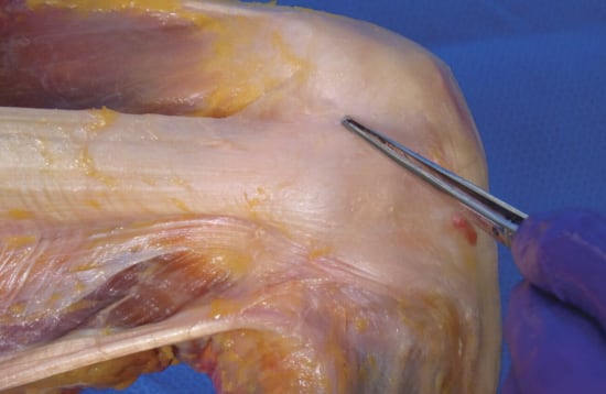 Photograph of a superficial dissection of the knee pointing, prominently showing the IT band.