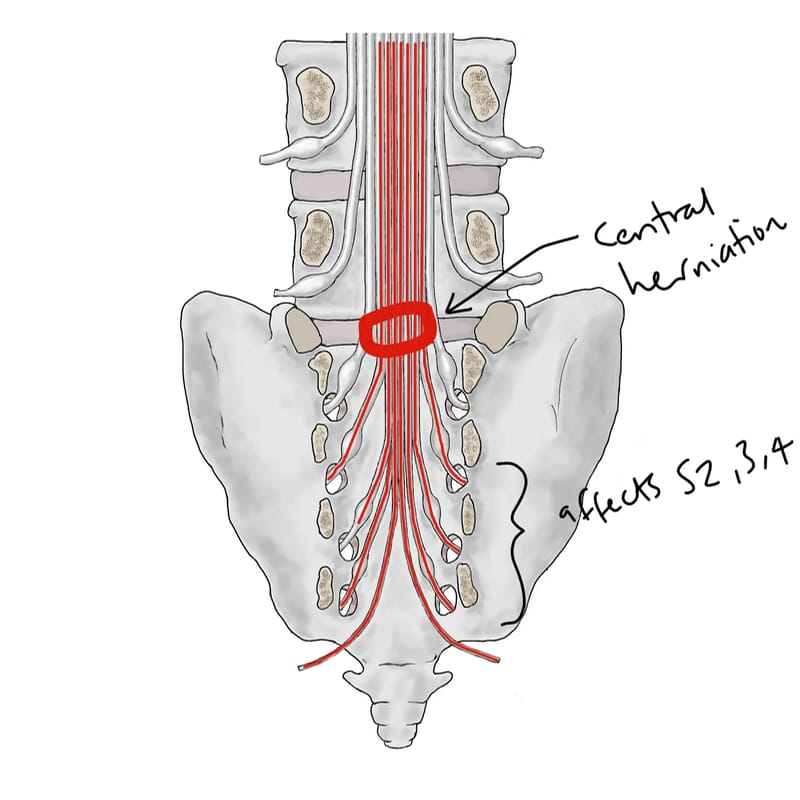 Posterior view anatomical illustration showing lumbar and sacral nerve roots descending through the spinal canal as the cauda equina. The red nerve bundle is labeled ‘central herniation’ at the L5-S1 level, with annotation indicating it ‘affects S2,3,4’ nerve roots. The illustration demonstrates how a central disc herniation can compress multiple sacral nerve roots simultaneously.