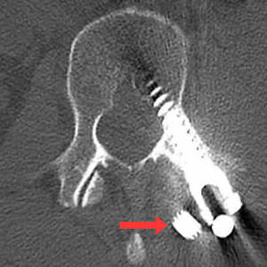 CT scan depicting a vertebrae in cross-section with clearly broken spinal fixations, a screw floating loose in soft tissue.