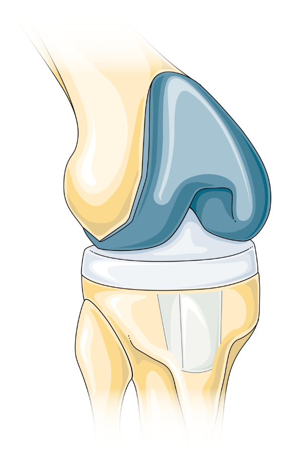 Illustration of total knee replacement.