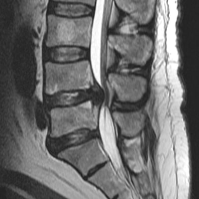 Spinal issues not linked to future back pain severity
