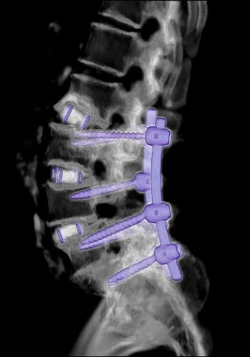 CT shows signs of instrumentation involving the vertebral bodies from L2 to S1: interbody spaces (cages) in L2-L3, L3-L4 and L4-L5 and pedicle screws are connected by rods that span multiple vertebral segments (L2 to S1).