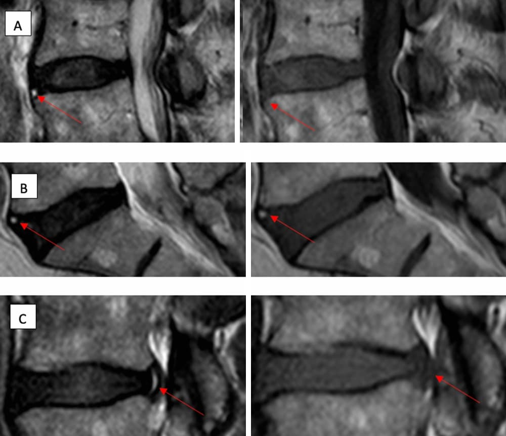 Example High Intensity Zones on T1 and T2-weighted Magnetic Resonance Imaging. A sagittal slice from the magnetic resonance imaging (MRI) of three different patients with high intensity zones (HIZ) with different T1-weighted MRI classifications. (a) Represents an anterior HIZ on T2W MRI with corresponding isointense signal on T1W MRI, (b) Represents an anterior HIZ on T2W MRI with corresponding hyperintense signal on T1W MRI and (c) Represents a posterior HIZ on T2W MRI with corresponding hypointense signal on T1W MRI.