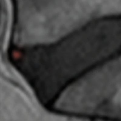 A greatly magnified detail view of a key part of an image from Sima et al., showing a high-intensity zone in an intervertebral disc highlighted in red — just a small dot, really.