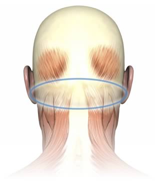 Anatomical drawing of the back of the skull, with a blue circle drawn around the suboccipital muscle group beneath the base of the skull.