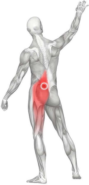 An example of the phenomenon of referred pain from a common trigger point in the supermedial gluteus maximus muscle.