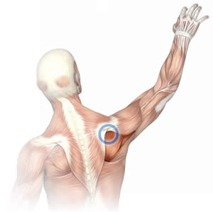 Anatomical illustration of the upper back musculature, showing the location of a common trigger point in the infraspinatus muscle.