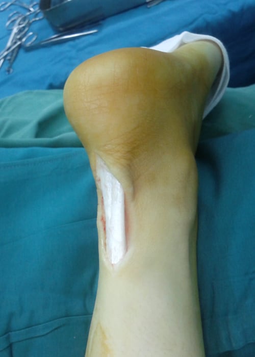 Photo of the back of a heel on blue-green surgical sheets. There is a large posterior incision fully exposing the shiny, white Achilles tendon.