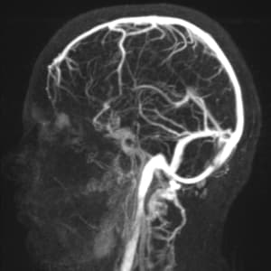 Normal image of a brain, a venogram highlighting the veins of the head.