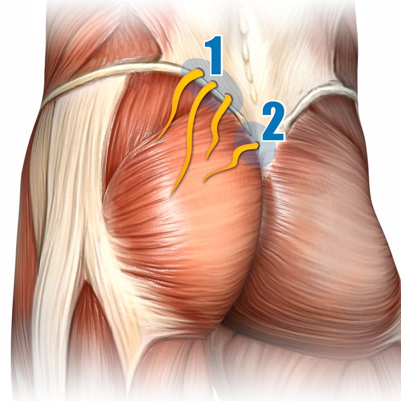 Hip and Butt Pain Trigger Massager