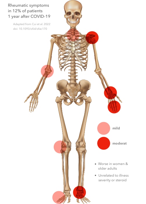Diagram of the human body showing joints most affected by rheumatic symptoms. adapted from Cui 2022, PMID # 35611349.
