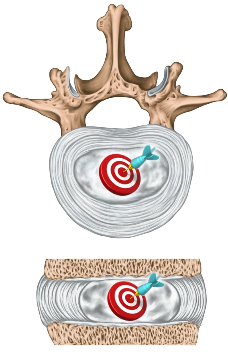 Two anatomical illustrations of a lumbar intervertebral disc show the target site for a therapeutic injection. The top image is an axial (top-down) view of the disc between vertebrae, with a red bullseye target centered in the nucleus pulposus and a blue dart embedded in it. The bottom image is a sagittal (side) cross-section showing the same target-and-dart motif within the disc. The images symbolize the precise delivery of an intradiscal injection of AMG0103 directly into the center of a degenerated spinal disc.