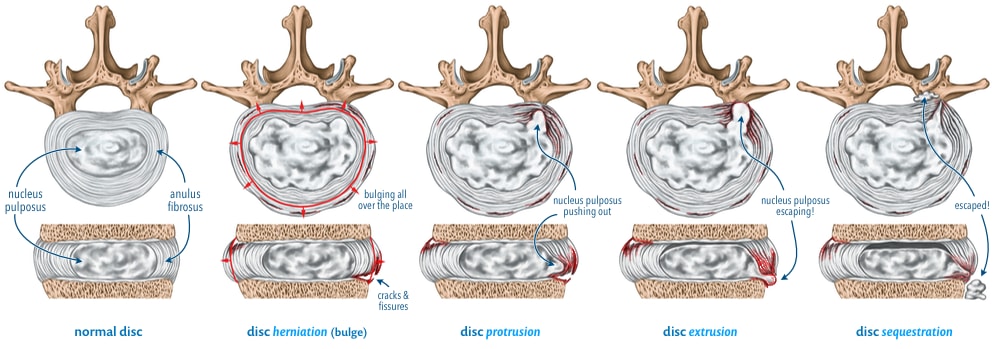 Diagram illustrating typical examples of disc herniations, protrusions, extrusions, and sequestrations.