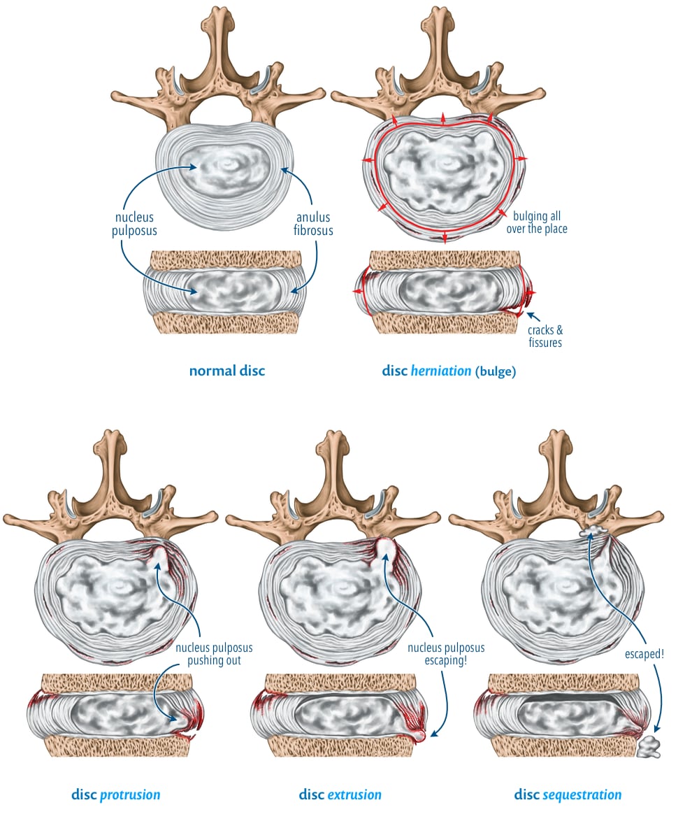 Diagram illustrating typical examples of disc herniations, protrusions, extrusions, and sequestrations.