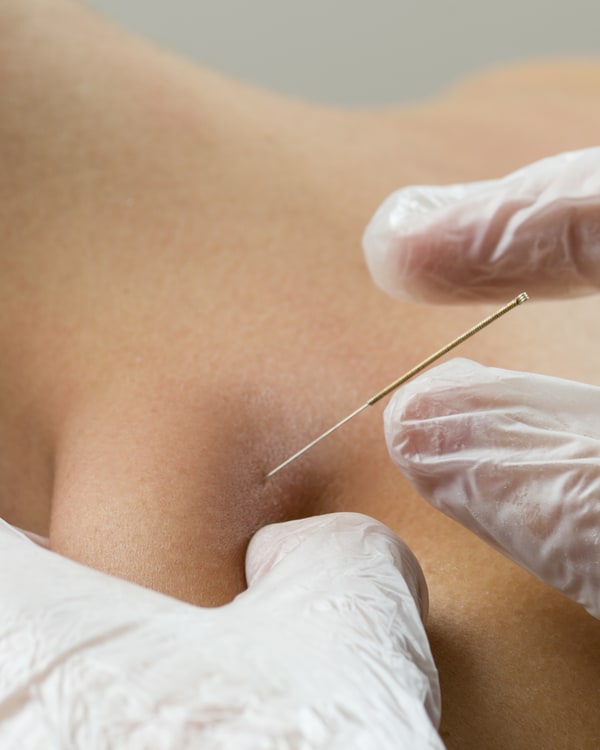 Closeup photo of hands in latex gloves inserting an acupuncture needle into a pinched bunch of muscle on the shoulder.