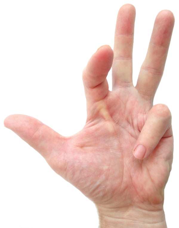 Stretching for a pathological contracture like this case of Dupuytren’s contracture is futile. This is a great example of a “technical” reason to stretch that many or most people would assume to be effective, but is not.