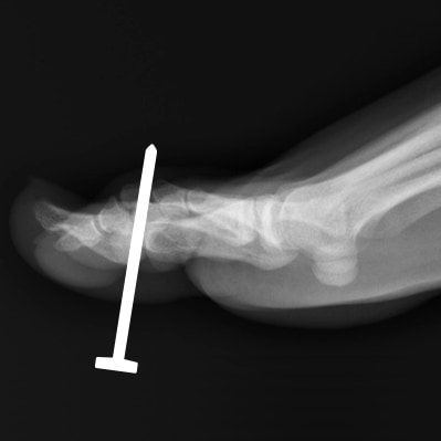X-ray image of a foot, with a nail embedded in the distal forefoot. Based on its position, it’s ambiguous whether it has passed between the toes.