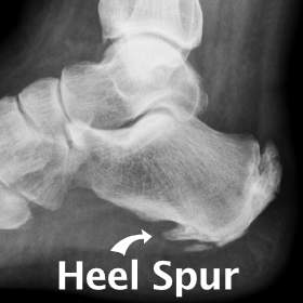 X-ray of a heel spur or bone spur.