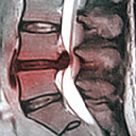 https://www.painscience.com/imgs/herniated-lumbar-disc-mri-1--sq-280x280-15k.jpg