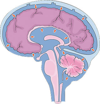 Diagram showing the brain being compressed by hydrocephalus.
