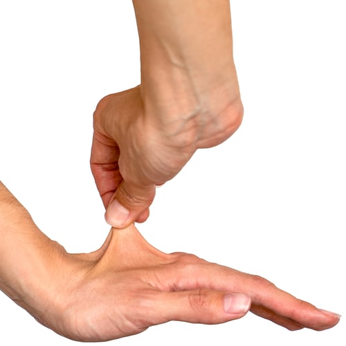 Photo one hand pinching the skin on the back of the other hand and lifting it up surprisingly far, a telltale sign of hypermobility.