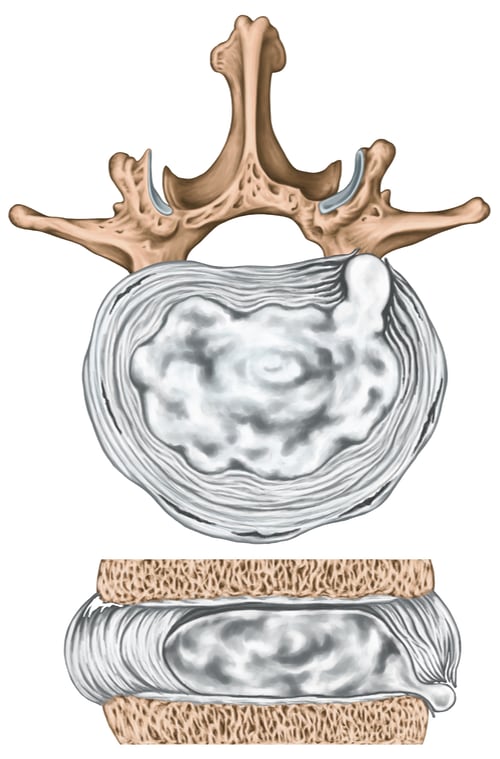 Diagrammatic illustration of a lumbar disc extrusion, showing the nucleus pulposus just barely emerging from a rupture in the annulus fibrosus.