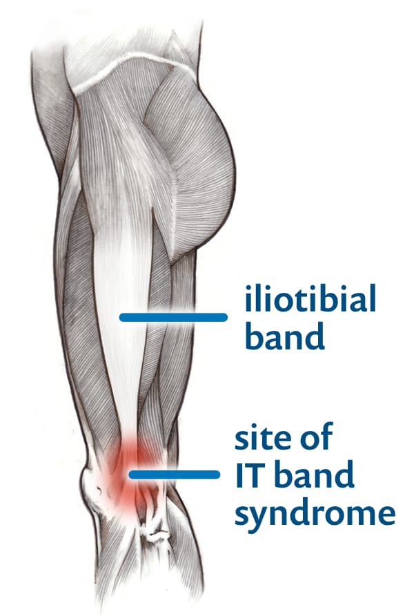 Illustrated diagram of the iliotibial band, a shallow dissection of the hip, thigh and knee, showing a broad white strap of tissue down the side of the thigh labelled “iliotibial band” and red highlight on the side of the knee labelled “site of IT band syndrome.”
