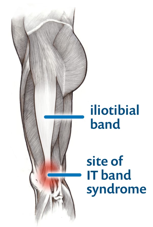 Iliotibial Band Friction Syndrome: Practice Essentials, Anatomy