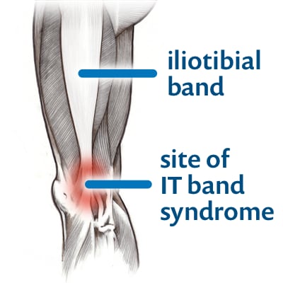 Hip pain is never about the IT band (I pinkie swear)
