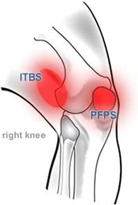 Diagram of the knee showing IT band syndrome on the side of the knee, and patellofemoral pain syndrome on the anteriorof the knee.