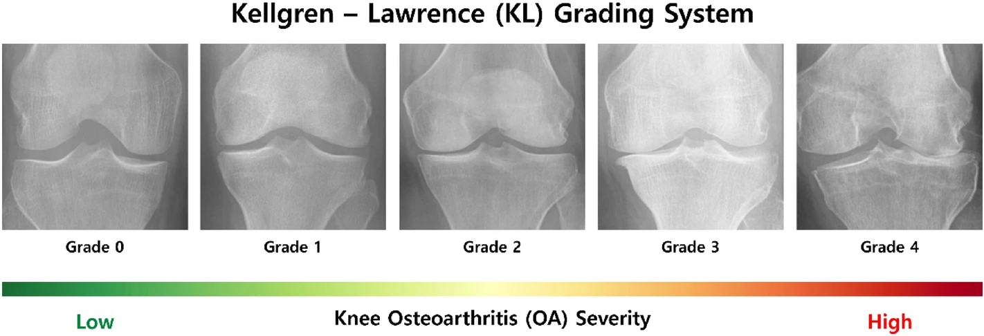 Knee joint x-ray showing severe, grade 4 osteoarthritis using the Kellgren-Lawrence grading system.