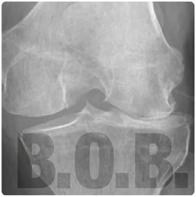 Knee joint x-ray showing severe, grade 4 osteoarthritis using the Kellgren-Lawrence grading system.