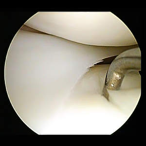 Arthroscopic view of a fissure in the tibial cartilage, at the tip of the instrument.