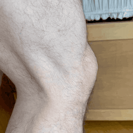 A short video of the author’s knee flexing, highlighting the way the IT band pops out.