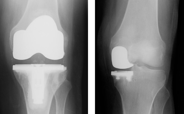 Two X-ray images, one of total knee replacement and one of partial. The total version shows at least 3-4 times the amount of metal in knee.
