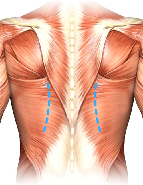 Diagram of the lower back, showing with bright blue dashed lines where to apply pressure to mobilize the <em>posterior</em> costovertebral joints. The lines roughly parallel the spine.