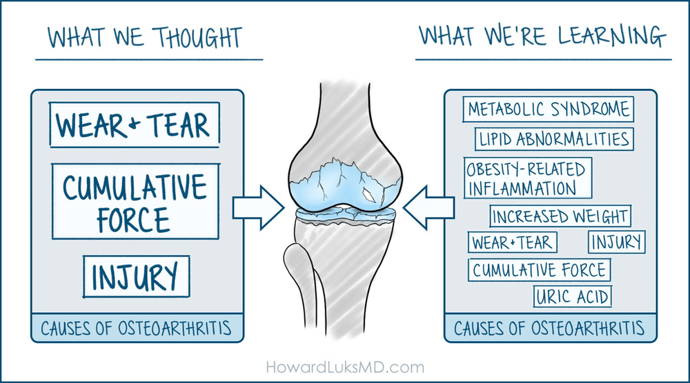 Simple infographic with an illustration of an arthritic knee in the middle and two text boxes on either side of it. The left side is titled “What we thought about the causes of arthritis” and the right “What we’re learning.” What we thought is: “wear and tear, cumulative force, injury.” What we’re learning is: “metabolic syndrome, lipid abnormalities, obesity-related inflammation, increased weight, wear & tear, injury, cumulative force, uric acid.”