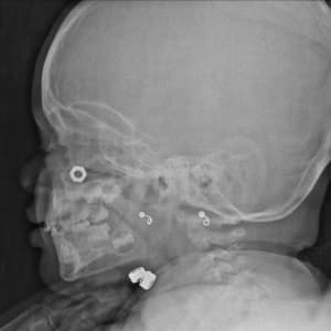 X-ray of a foreign object, a hexagonal nut, stuck in a baby’s nose.