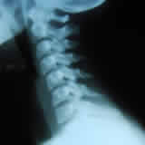 Research has shown that abnormal curvature of the cervical spine is actually <em>not</em> closely associated with neck pain.
