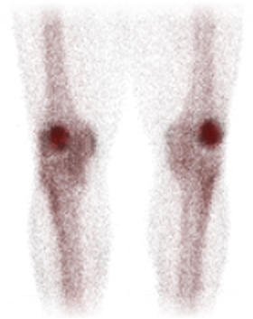 A bone scan of patellefemoral pain, showing the faint grainy shapes of thigh and shin bones, even fainter outlines of soft tissue, and very dark kneecaps standing out boldly.