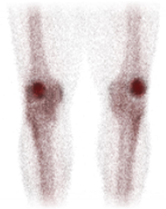 A bone scan of patellofemoral pain, showing the faint grainy shapes of thigh and shin bones, even fainter outlines of soft tissue, and very dark kneecaps standing out boldly.