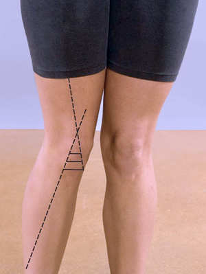 Example of the kind of significant Q-angle that was not found in injured runners.