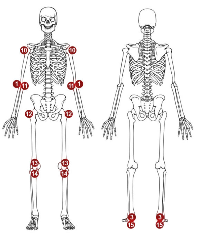 Diagram of the 18 sites of pain highlighted by the SPARCC Enthesitis Index.