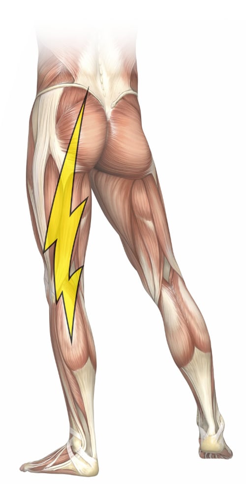 Illustration of the superficial muscular anatomy of the legs, with a bold lightning bolt superimposed on one leg to represent sciatica.