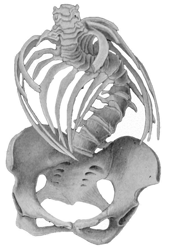 Vintage illustration of an extremely scoliotic spine, including rib cage and pelvis.