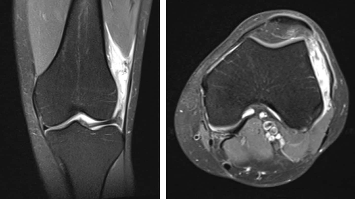 A mair of MRI images of a knee, one straight on, the other top-down.